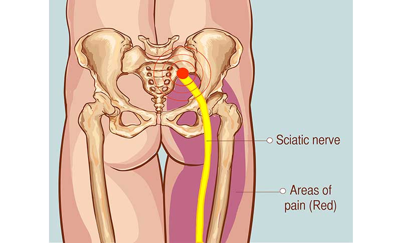 Piriformis Syndrome - South Vancouver Physiotherapy Clinic