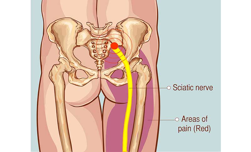 Sciatic Nerve Entrapment: A real pain in the butt