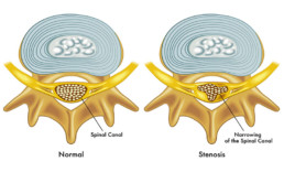 spinal stenosis definition