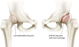 arthritic hip joint