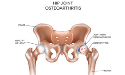 osteoarthritis hip