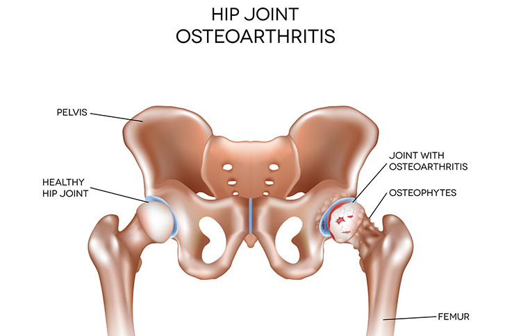 Piriformis Syndrome - South Vancouver Physiotherapy Clinic