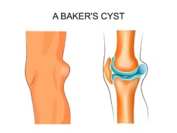 best-knee-wrap-for-bakers-cyst