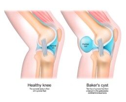 what-is-a-bakers-cyst